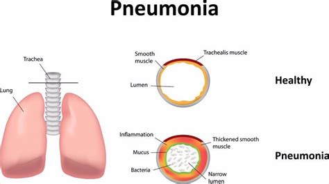 Causes And Types Of Pneumonia