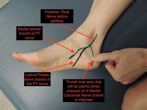 A Guide To Conservative Care For Plantar Fasciitis