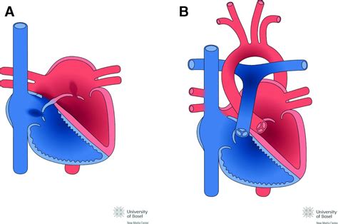 Simple Cardiac Shunts In Adults Atrial Septal Defects Ventricular