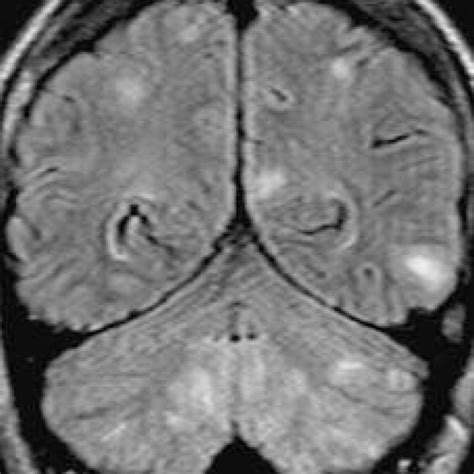 Pdf Joubert Syndrome Associated With New Mri Findings And Posterior