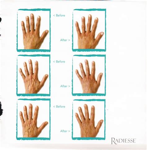 do you hands give your age away fear not with radiesse dermal fillers we can reverse the
