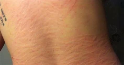 What Is Dermatographia Symptoms Cause Risk Factors And How To Treat