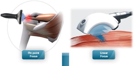 Shockwave Therapy Motus Physical Therapy