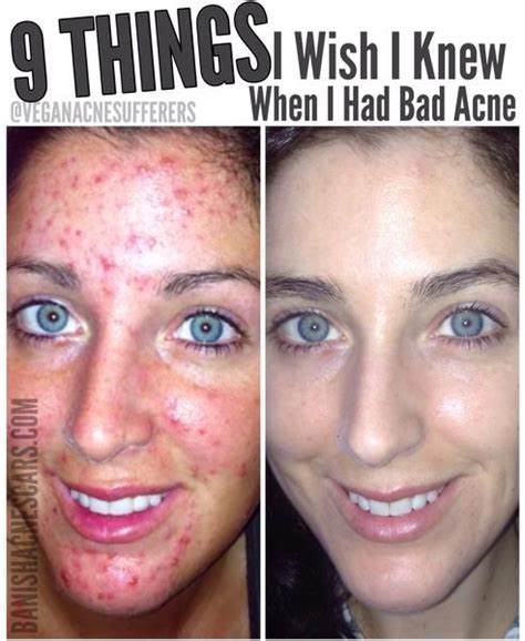 Pin On Getting Rid Of Acne And Scars