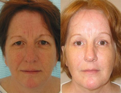 Forehead Lift Before And After Fairfax And Washington Dc