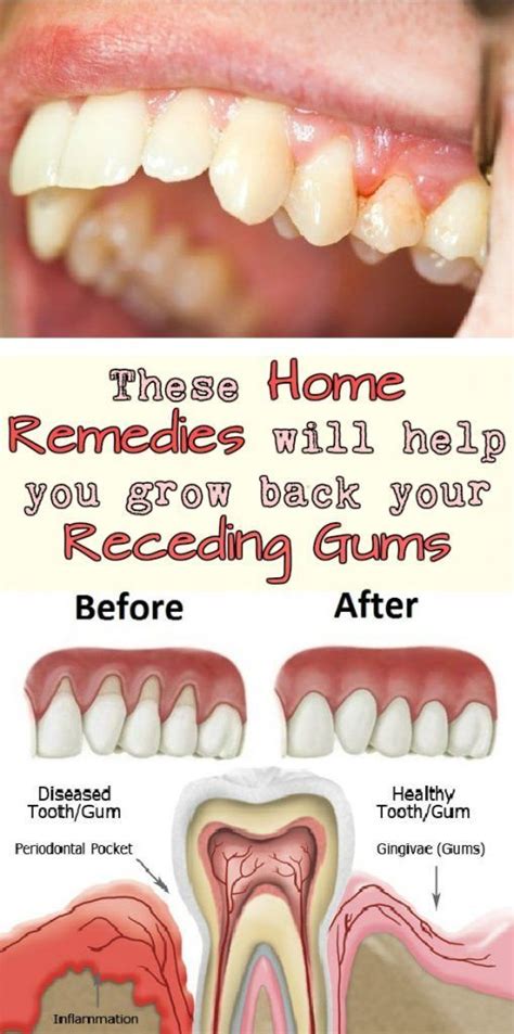 These Home Remedies Will Help You Grow Back Your Receding Gums Gum