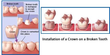 How much do crowns cost? Crowns & Bridges - Sacramento dentist Stephen A. Genus, D.M.D.
