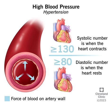 إرتفاع أو فرط ضغط الدم استشارات طبيب دوت كوم