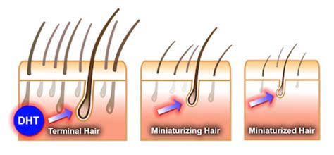 However, unlike the postpartum period, hair loss in menopause is irreversible, unless hormone replacement therapy is introduced. Hereditary Hair Loss