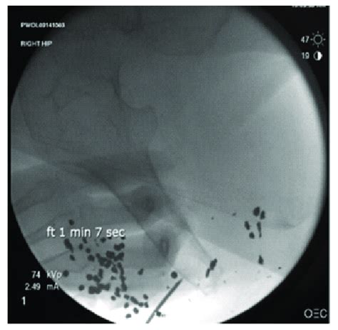 Intraoperative Radiograph Showing Location Of Distal Femoral Traction