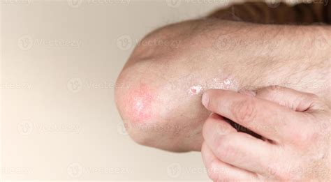 Psoriasis On The Elbow 2429376 Stock Photo At Vecteezy