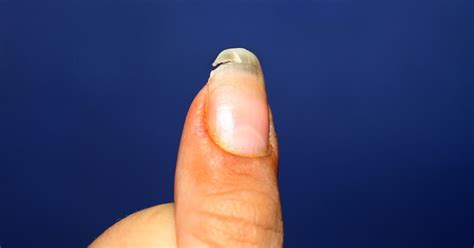 Split Nail Causes Treatment And Prevention Split Nails How To