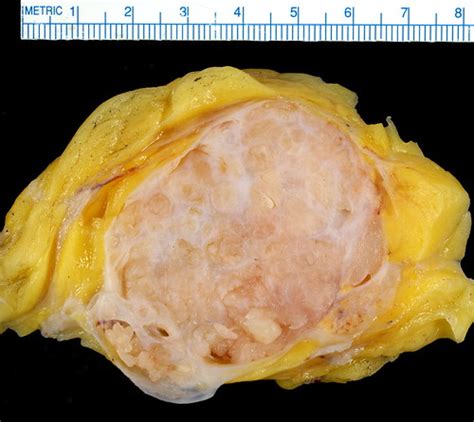 Phyllodes Tumor Gross Ed Uthman Flickr