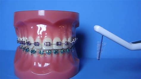 Getting Started With Braces Your Complete Guide To Oral Hygiene Youtube