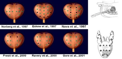 Transrectal Multiple Core Prostate Biopsy