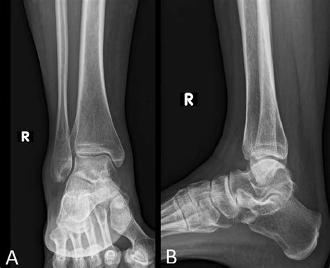 Radiographs Showing The Anteroposterior And Lateral V