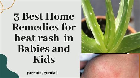 Best Home Remedies For Heat Rash In Babies And Kids Youtube