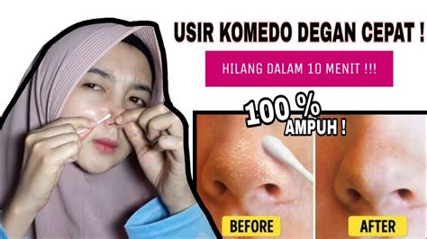 5 cara mudah merapikan bulu hidung yang kerap mengganggu penampilan. CARA MENGHILANGKAN KOMEDO DI HIDUNG | Cepat & Mudah - YouTube