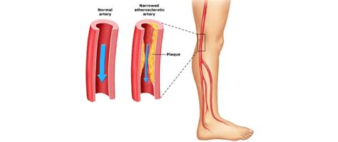 Peripheral Arterial Disease Pad