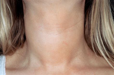 Clinical Review Hypothyroidism Gponline