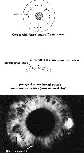 Lasso Procedure To Revise Overcorrection With Radial Keratotomy American Journal Of Ophthalmology