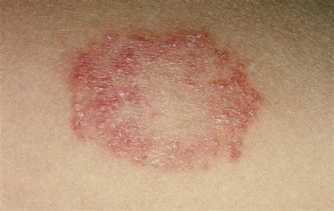 10 Signs And Symptoms Of Ringworm