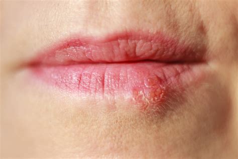 mouth ulcers and cold sores what s the difference