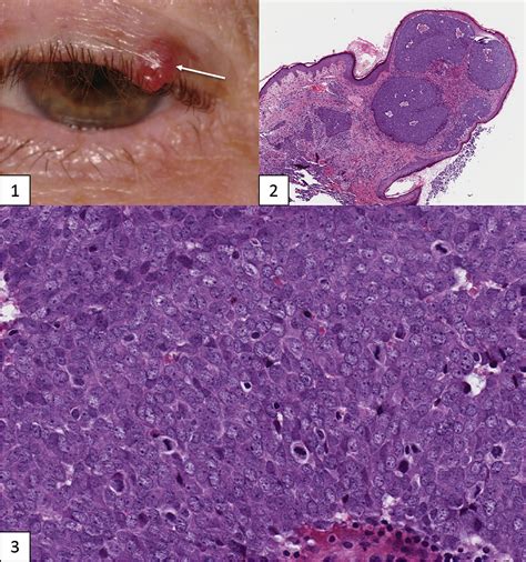 It is a nondendritic, nonkeratinocytic, epithelial clear cell normally found in the epidermis and dermis of mammals and humans. Merkel Cell Carcinoma of the Eyelid - Ophthalmology