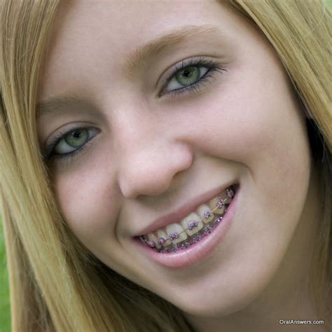 List 92 Pictures Show Me Pictures Of Braces Sharp
