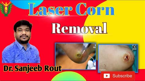 Laser Corn Removal Dr Sanjeeb Rout Balaji Skin And Hair Talcher