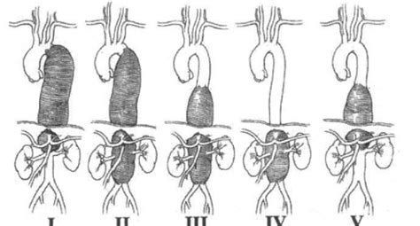 Crawfords Classification Of Thoracoabdominal Aortic Aneurysms 8