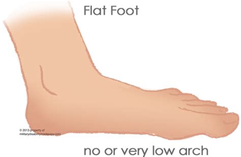 What Are Limitations Of Having Flat Feet Quora