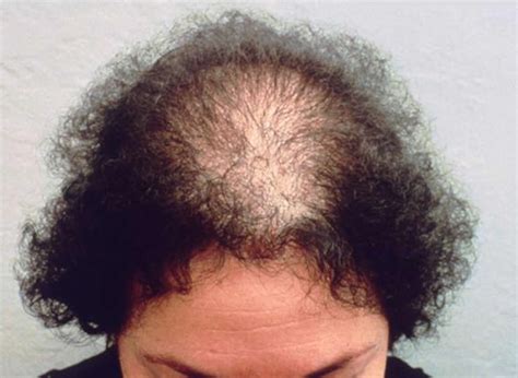 Hair Loss In Women And Men Causes Diagnosis And Hair Loss Treatment