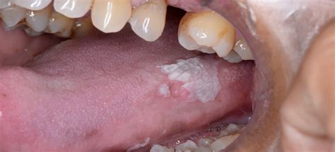 Oral Potentially Malignant Disorders Advice On Management In Primary