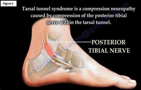 Tarsal Tunnel Syndrome A Carpal Tunnel Like Syndrome Of The Foot