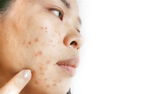 Can Pigmentation Hyperpigmentation Be Removed From The Skin