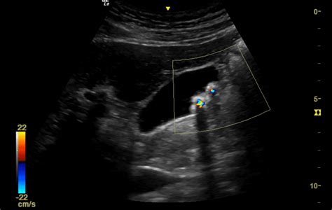 Using Point Of Care Ultrasound For Gallstone Diagnosis