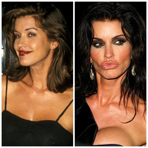 Celebrity Plastic Surgery Gone Wrong Before And After