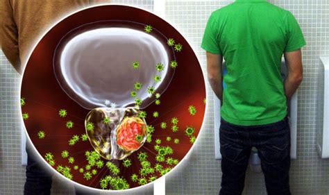 The five most common signs of cancer in young people are: Prostate cancer symptoms: Signs of tumour include a weak ...
