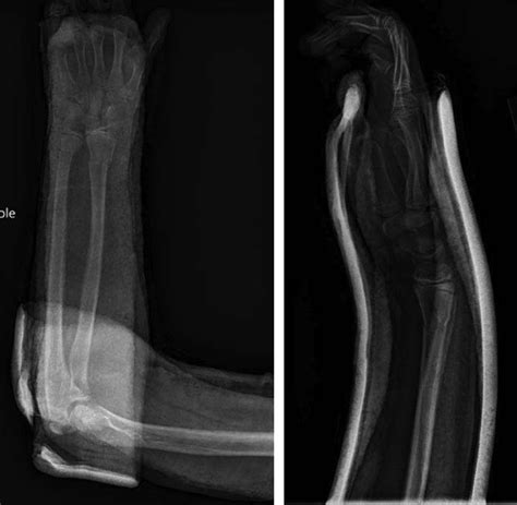 Ap And Lateral Radiographs Demonstrating Postreduction And Casting