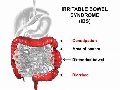 Bowel Irritable Syndrome Illustration Treatment