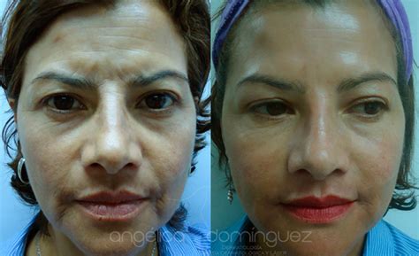 Contar con un buen especialista en tratamientos faciales, puesto que los resultados dependen de la musculatura del paciente, la técnica empleada y la destreza del. Botox® Fotos Antes y Después