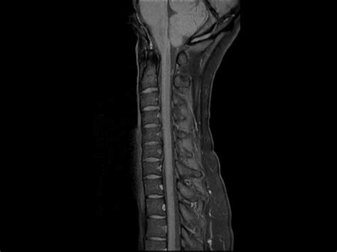 Cervical Spine Imaging With Mdixon Tse Philips Mr Body Map