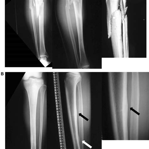 Initial Radiographs Show Suspected Tibial Stress Fracture Or Shin