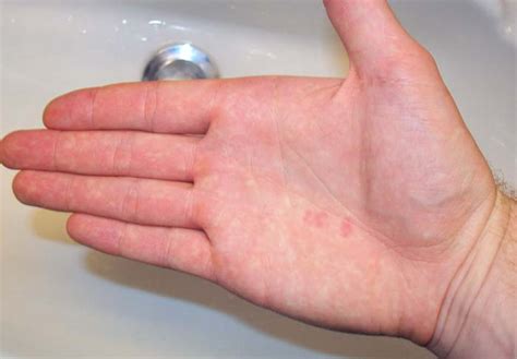 Red Spots On Palm Of Hand Pictures Photos