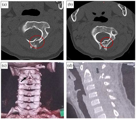 Ct Cervical Spine A And B C2 Lamina Fracture On The Left Side Red