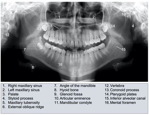 Mandibular Fractures Anatomy Management Geeky Medics