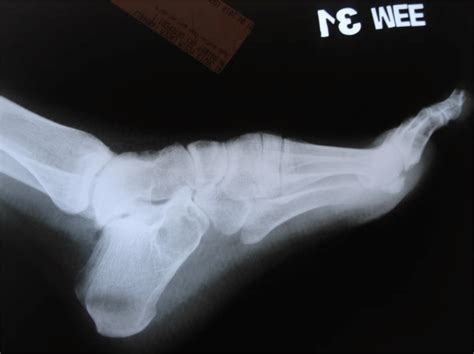 Preoperative Lateral X Ray View Of Giant Cell Tumor Of Calcaneus