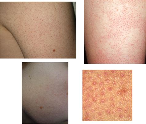 Are The Red Bumps On Your Arms Keratosis Pilaris Dorothee Padraig My