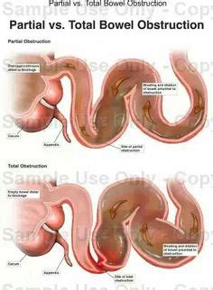 Other bowel obstruction causes can include cancer or a hernia, but those cases are rare, dr. Recurring bowel obstruction adhesions can form inside the ...